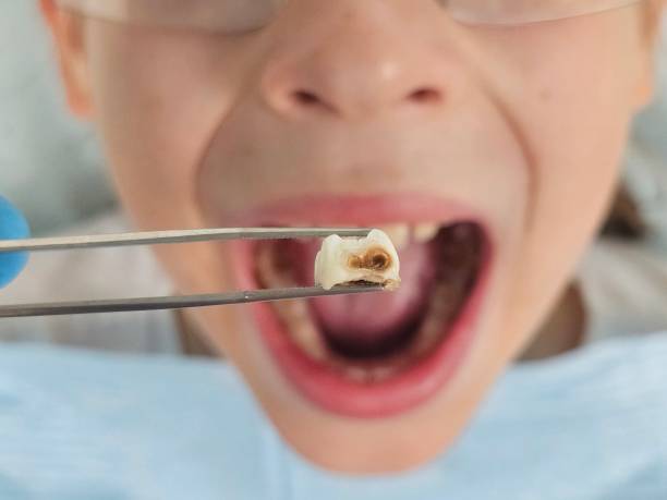 Best Emergency Tooth Extraction in Kapaa, HI